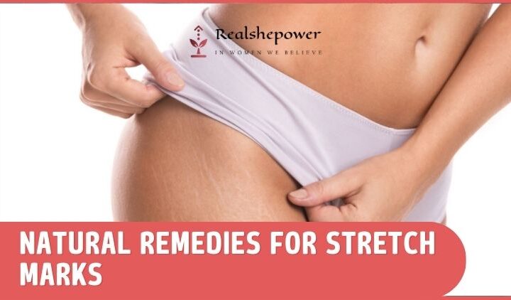 Natural Remedies For Stretch Marks: 6 Effective And Safe Alternatives