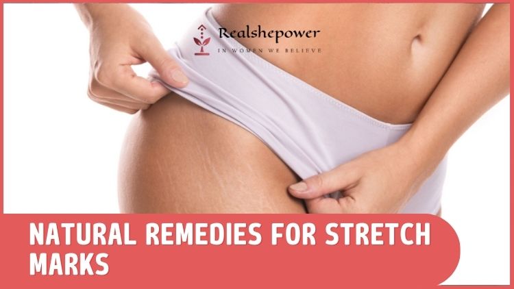 Natural Remedies For Stretch Marks: 6 Effective And Safe Alternatives