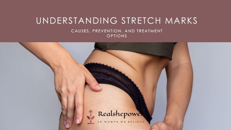 Understanding Stretch Marks: Causes, Prevention, And Treatment Options