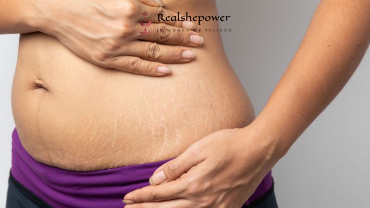 Understanding Stretch Marks: Causes, Prevention, And Treatment Options