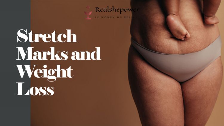 Stretch Marks And Weight Loss: Understanding The Connection