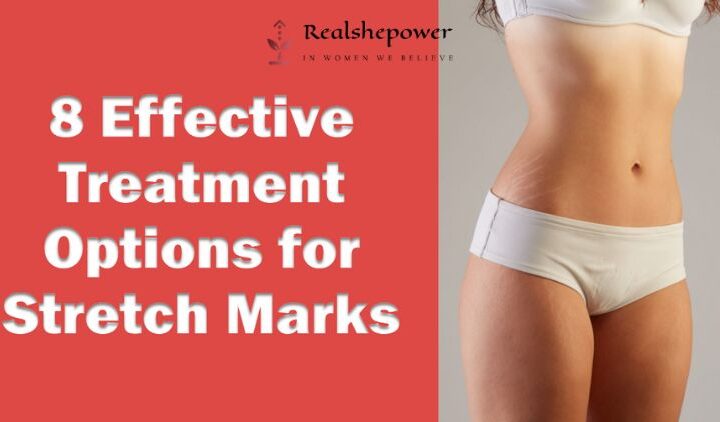 8 Effective Treatment Options For Stretch Marks: Say Goodbye To Insecurities