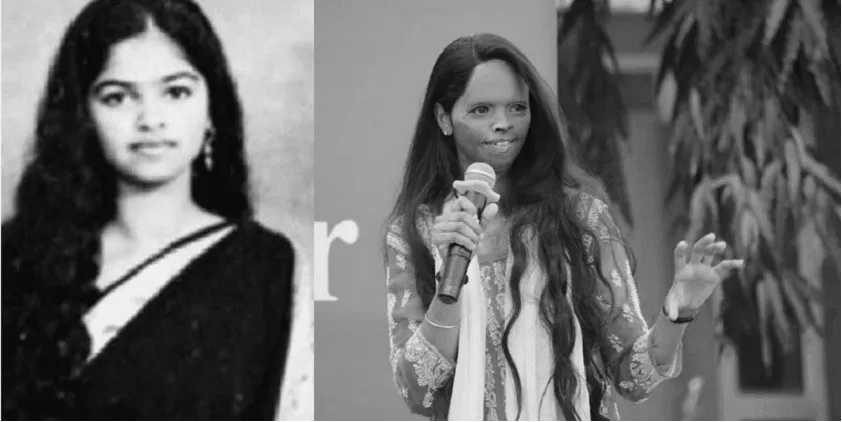 Acid Attack Survivor
