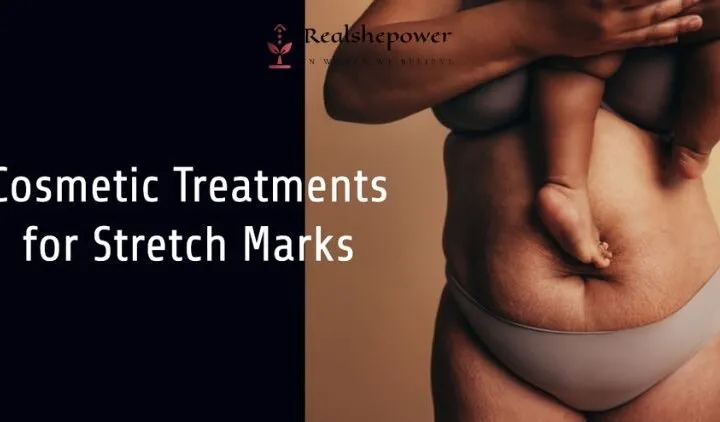 Cosmetic Treatments For Stretch Marks: Are They Worth The Investment?