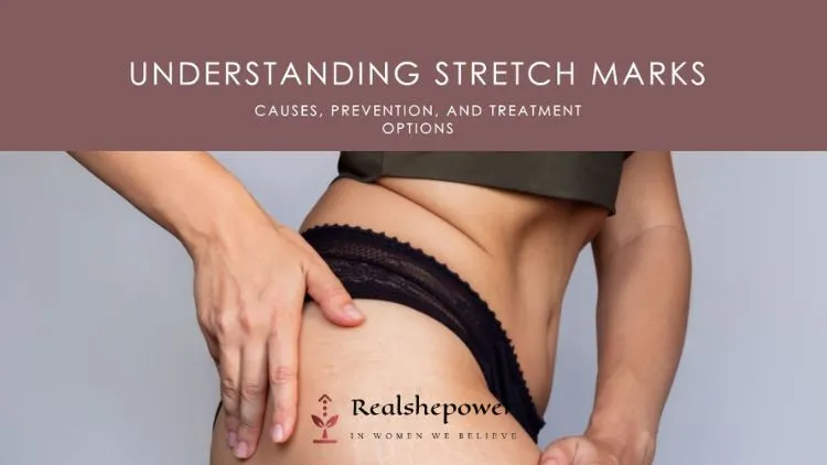 Top 7 Products For Treating Stretch Marks 11 Understanding Stretch Marks: Causes, Prevention, And Treatment Options