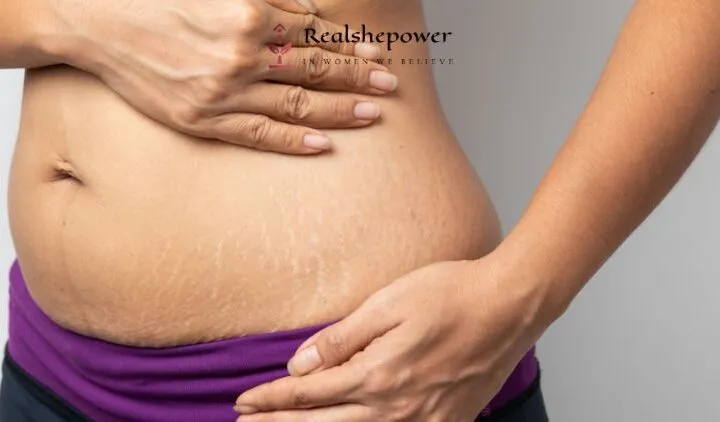Understanding Stretch Marks: Causes, Prevention, And Treatment Options