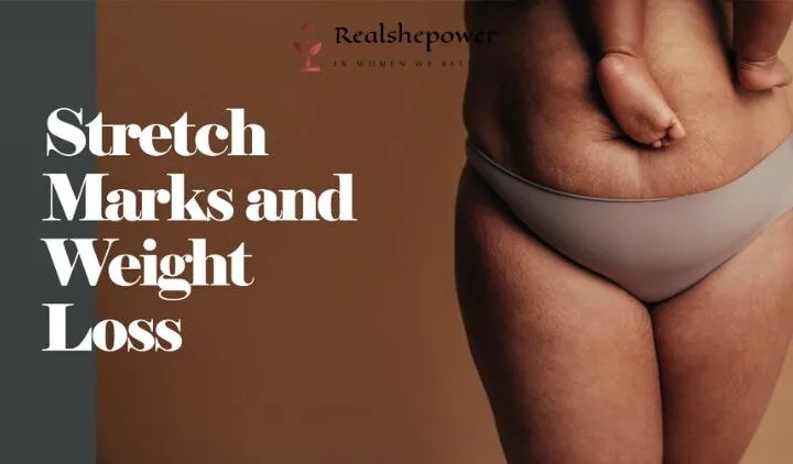 Stretch Marks And Weight Loss: Understanding The Connection